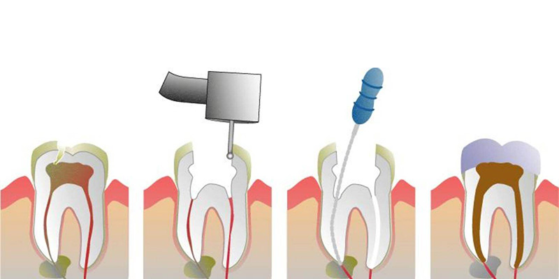 Kanal Tedavisi (Endodonti )