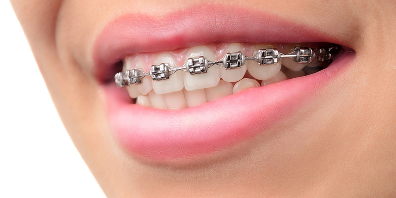 ortodonti-tedavisi-2